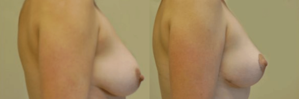 35 year old female before and after breast lift side view