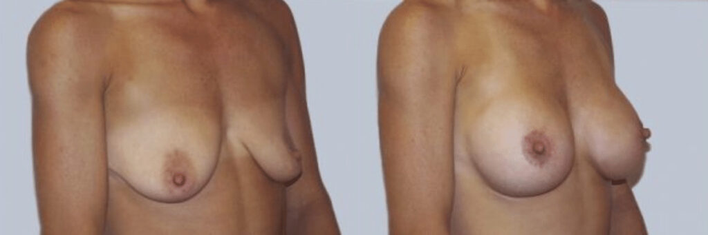 35 year old female before and after breast lift and augmentation front view