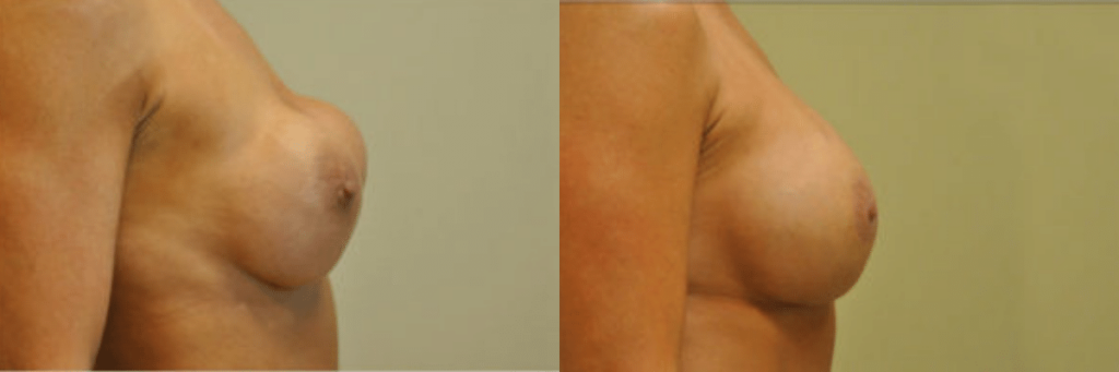 43 year old breast revision for severe asymmetry with capsular contracture, breast hardening before and after side view