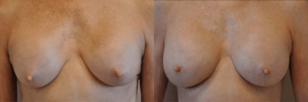 63 year old female capsular contracture surgery before and after front view