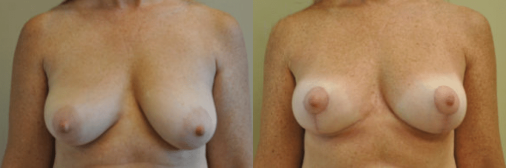 48 year old female 2 months post op before and after breast lift front view