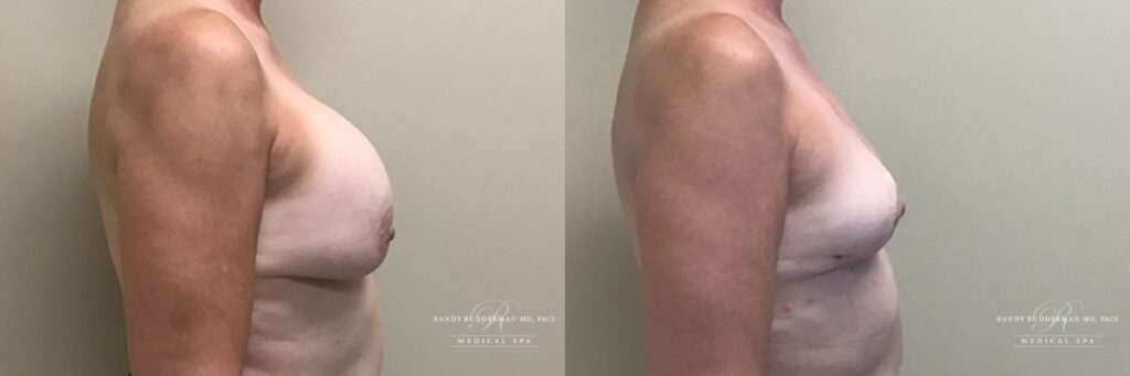 Breast implant removal, total capsulectomy and lift before and after side view