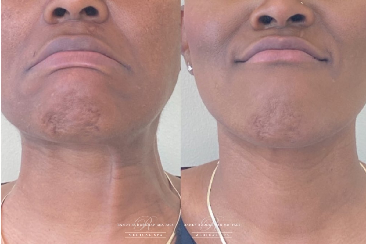 before and after lower face botox correction