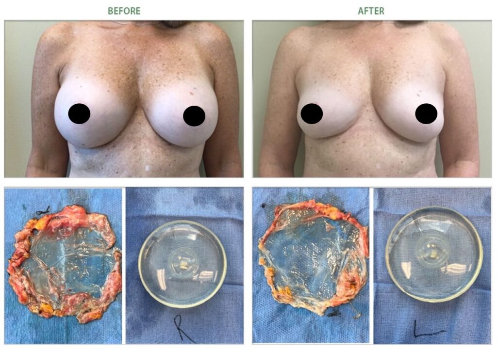 grade 1 capsular contracture breast implant removal before after 6980