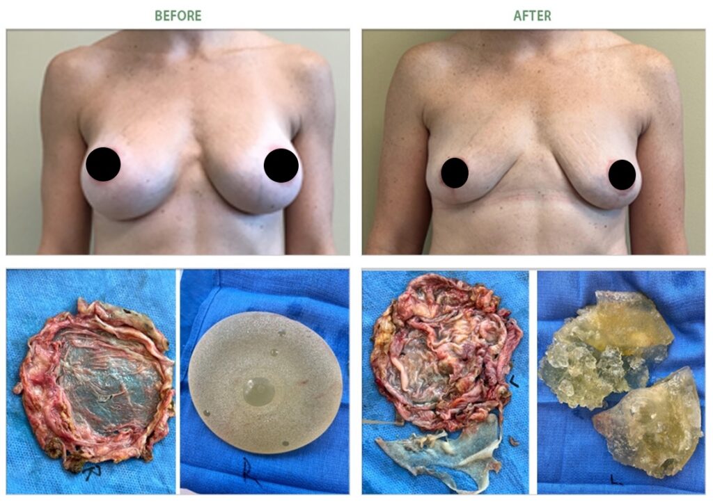grade 1 capsular contracture breast implant removal before after 6982