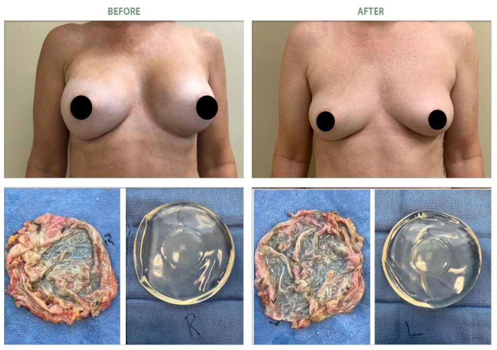 grade 2 capsular contracture breast implant removal before after 6983