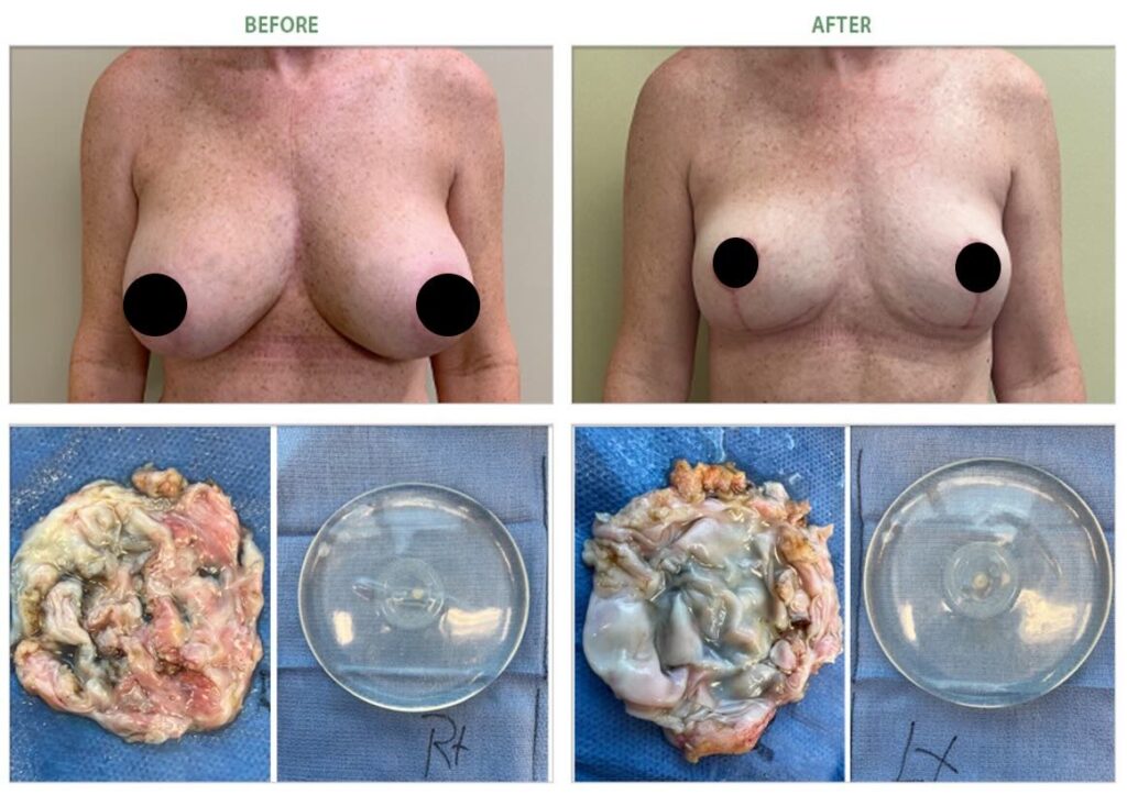 grade 2 capsular contracture breast implant removal-before after 6984
