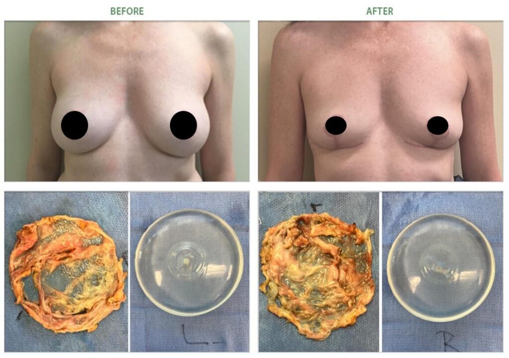 grade 3 capsular contracture breast implant removal 6985