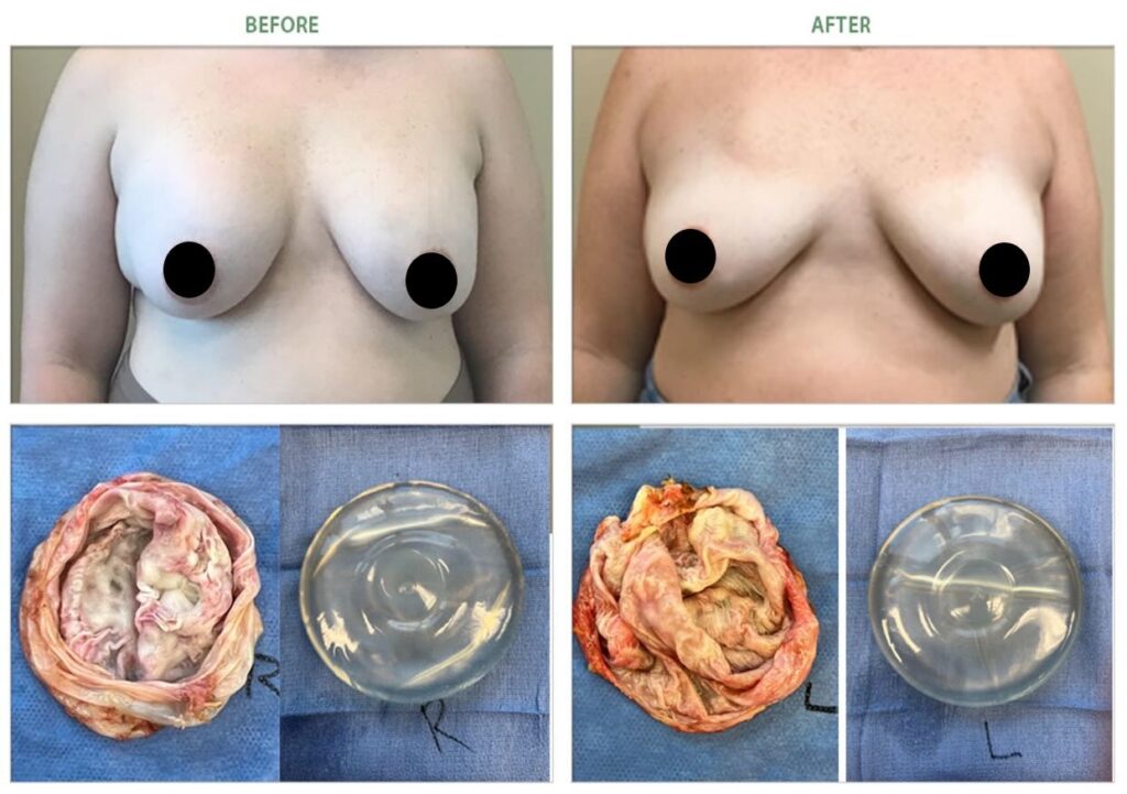 grade 3 capsular contracture breast implant removal before after 6986