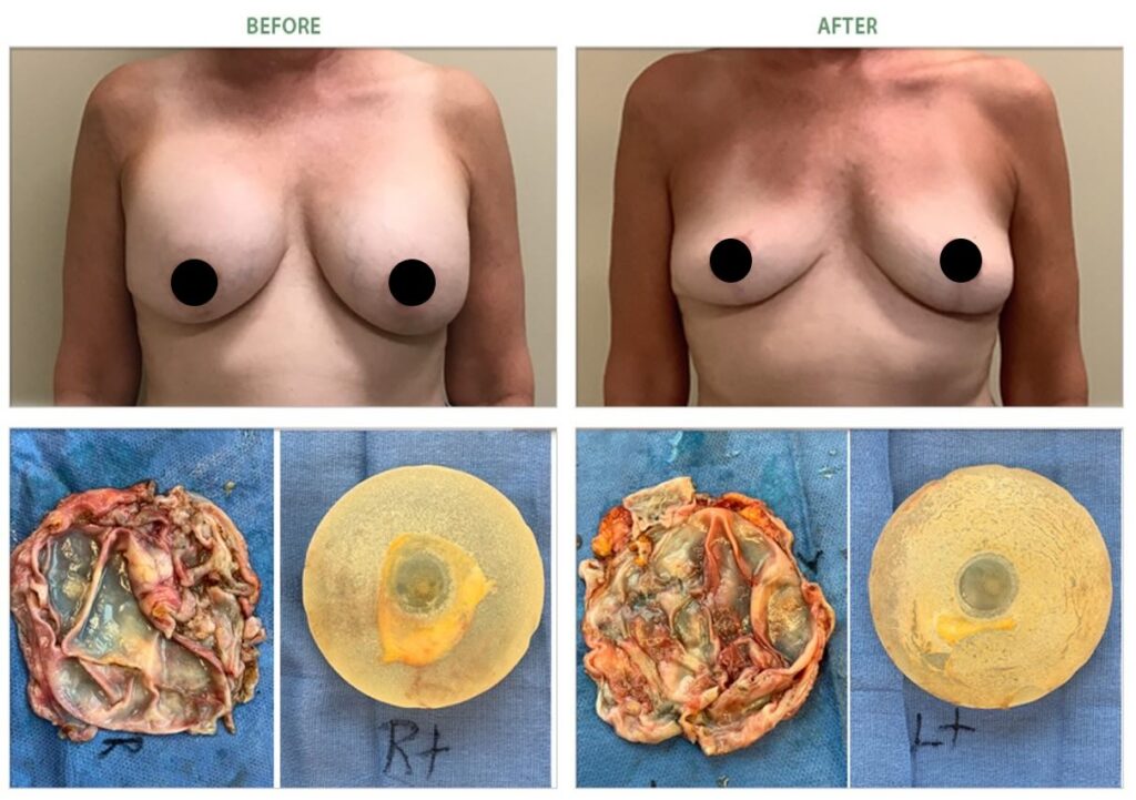 grade 4 capsular contracture breast implant removal before after 6987