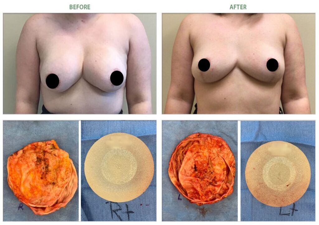 grade 4 capsular-contracture breast-implant removal before-after