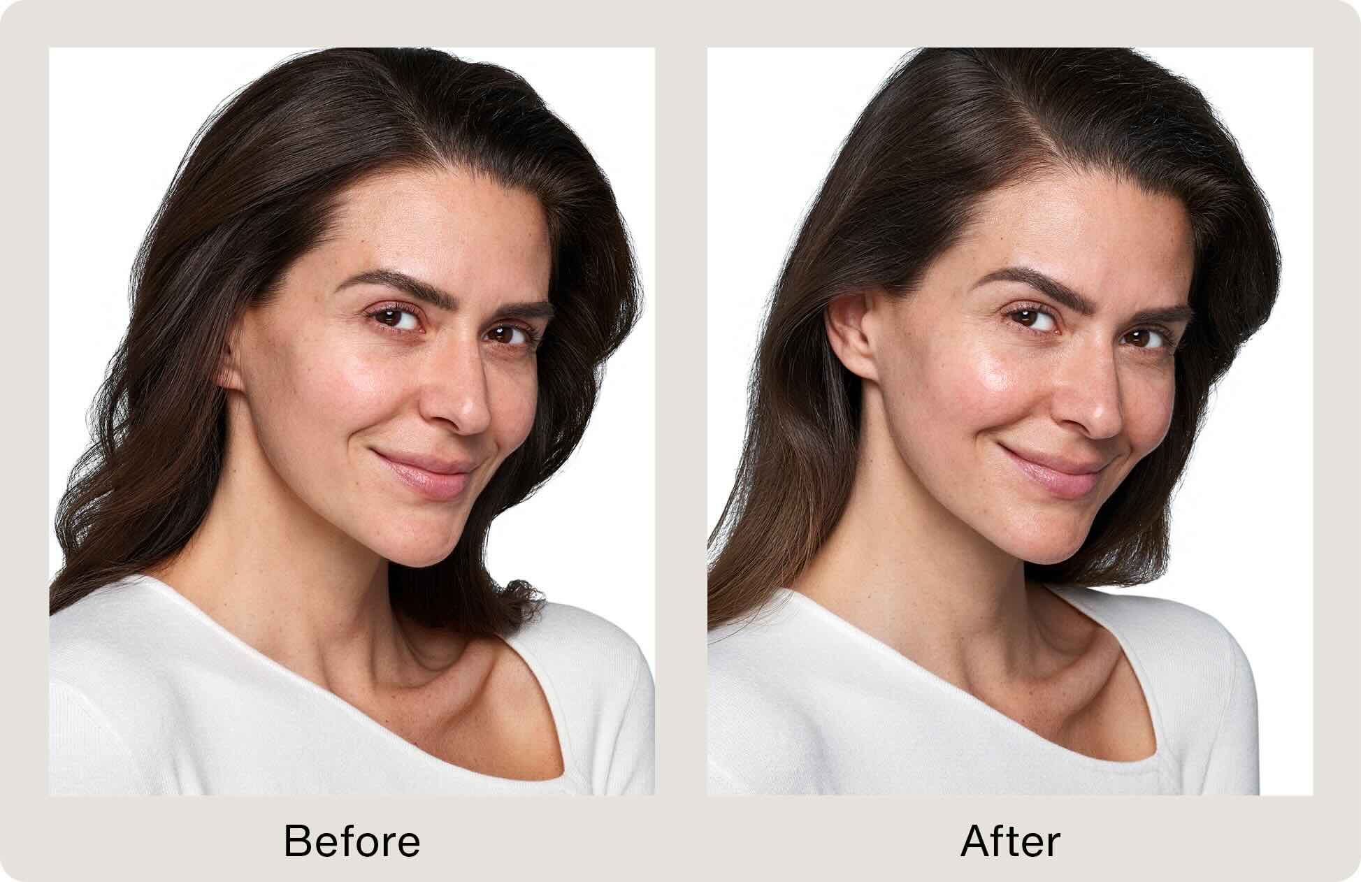 JANINA
Real patient treated with SKINVIVE™ by JUVÉDERM®. Actual results may vary.

BEFORE
AFTER
Before and after treatment of the cheeks treated with SKINVIVE™ by JUVÉDERM®