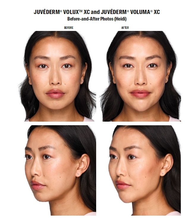 Juvederm Volux XC before and after Heidi