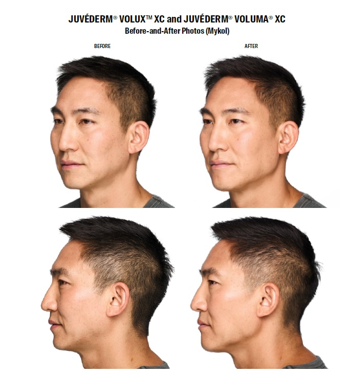 Juvederm Volux XC before and after male