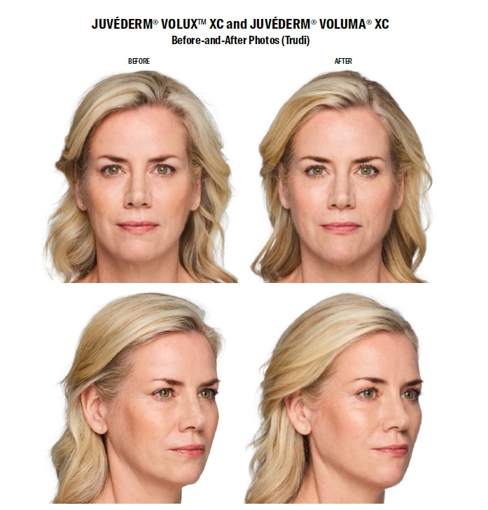 Juvederm Volux XC before and after female