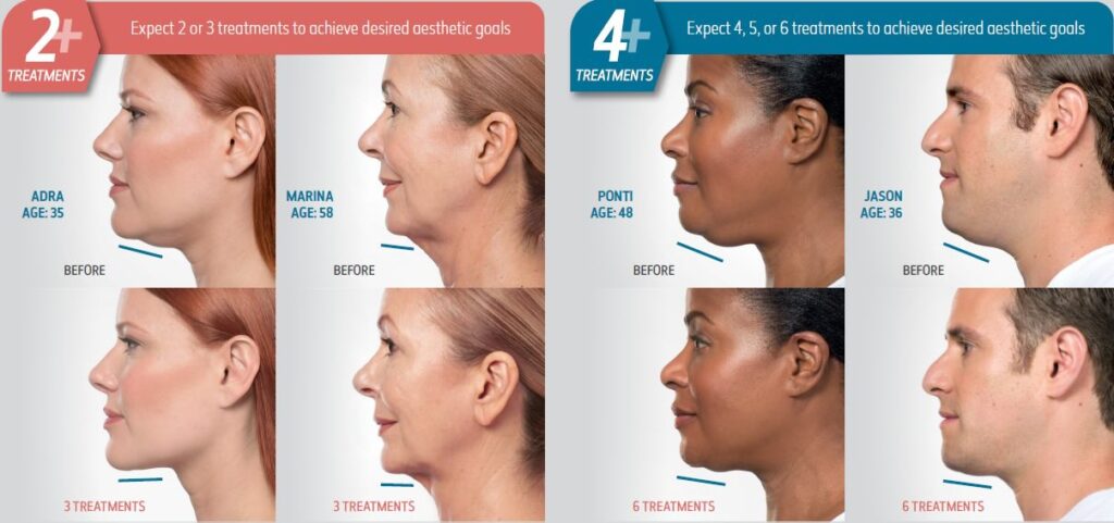 Kybella 2 vs. 4 treatment comparison