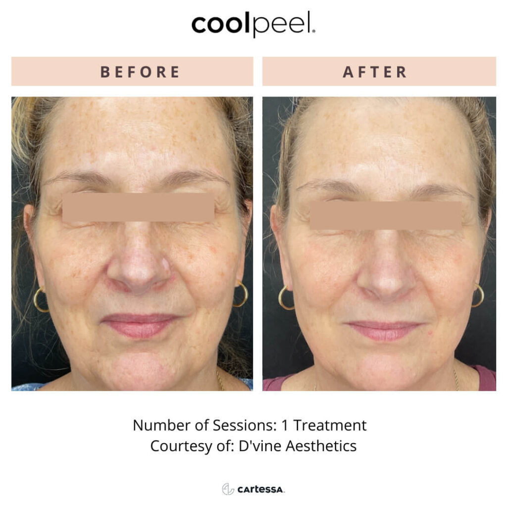 CoolPeel female before and after 1 treatment on face