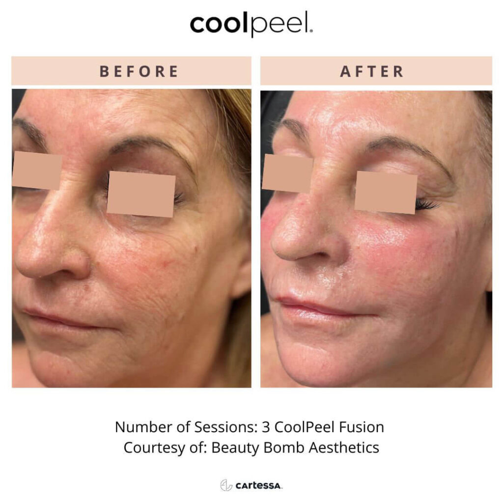 CoolPeel fusion laser treatment female before and after 3 sessions on face