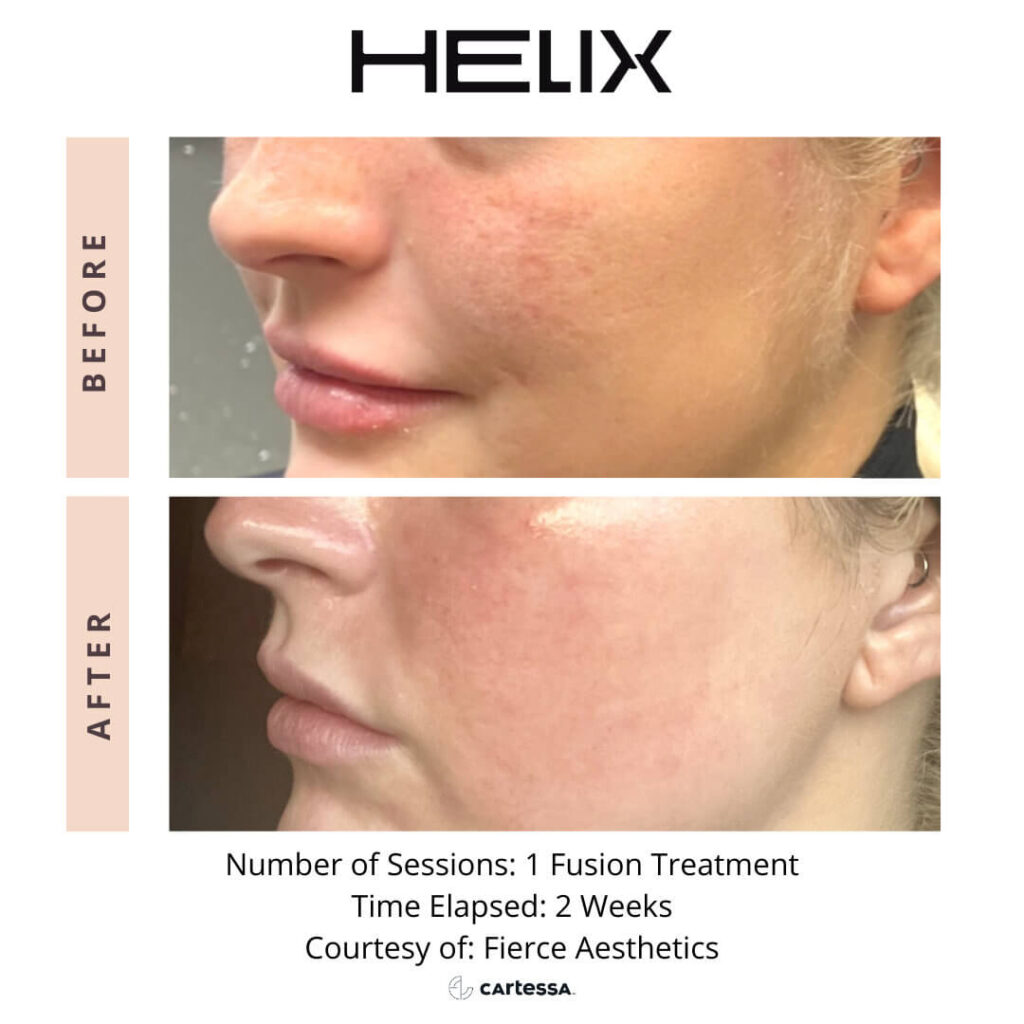 Helix laser fusion treatment female before and after 1 treatment on cheeks