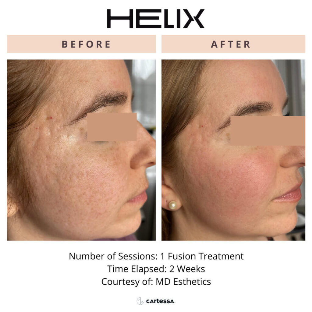 Helix laser fusion treatment female before and after 1 session on face