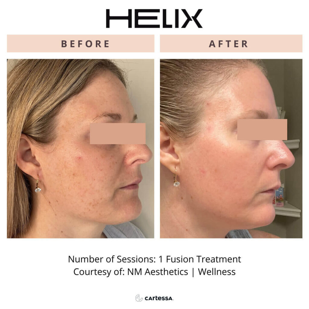 Helix laser female before and after 1 fusion treatment on face