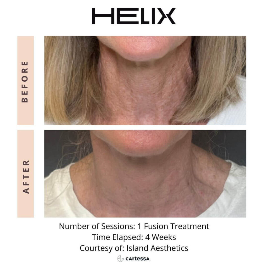 Helix laster fusion treatment female before and after 1 treatment on neck