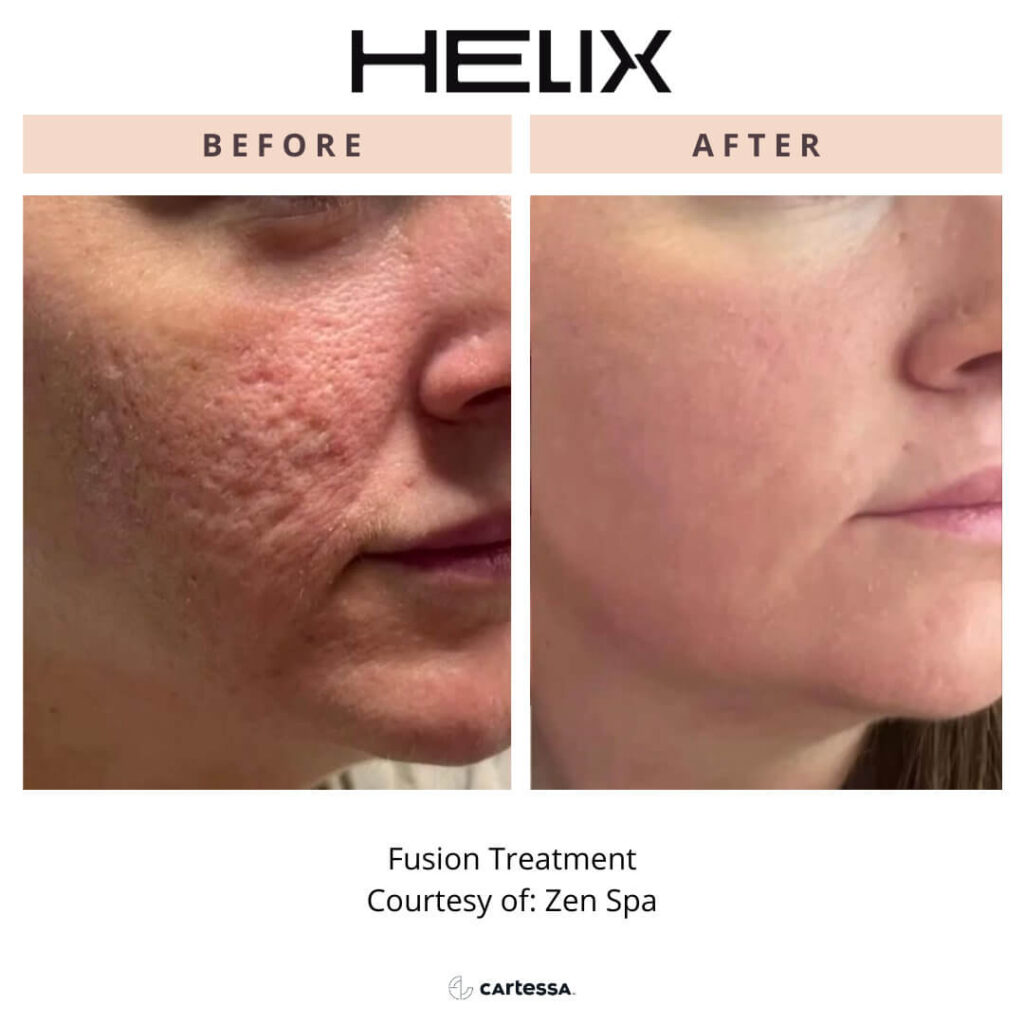 Helix laser fusion treatment female before and after on cheeks