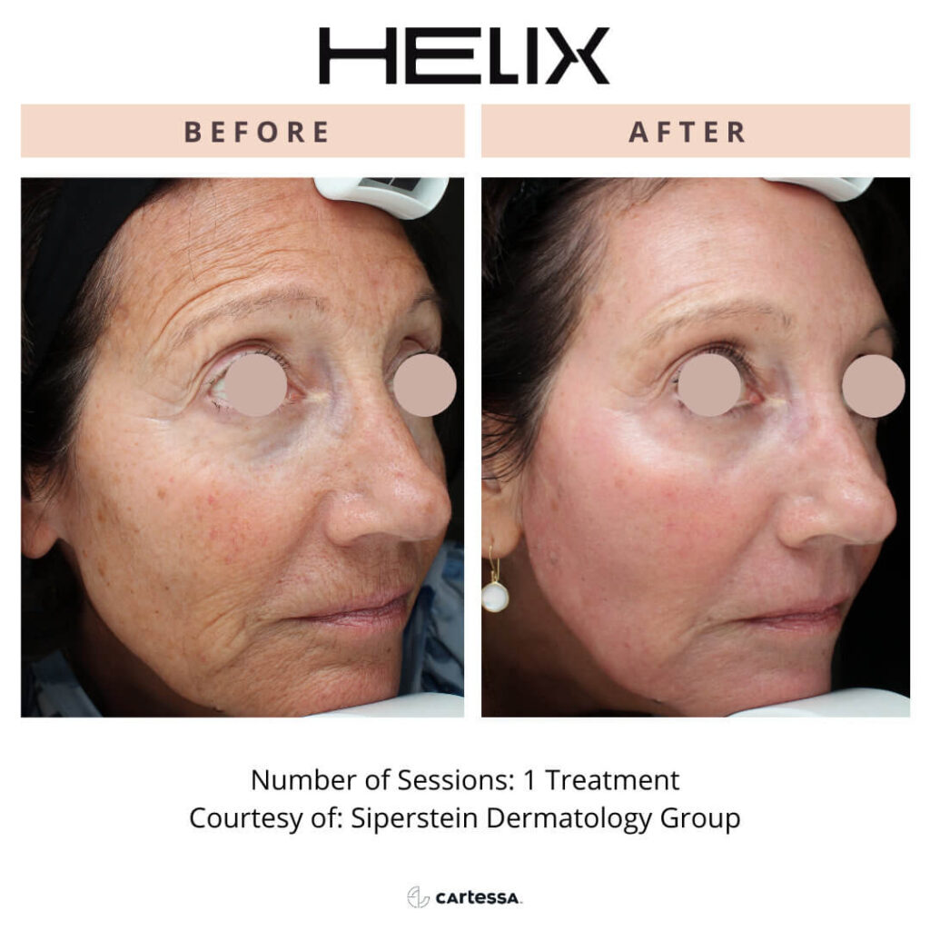 Helix laser female before and after 1 treatment on face